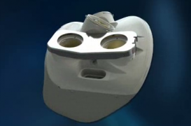 Première mondiale : comment fonctionne le coeur artificiel